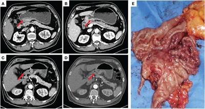 Gastric paraganglioma: a case report and review of literature